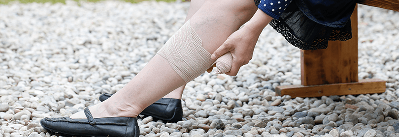 Manchas na perna podem ser sinal de problema vascular